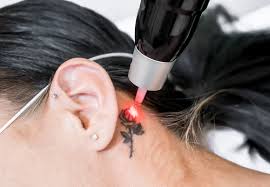 Tattoo removal