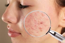 Acne and acne scar treatment