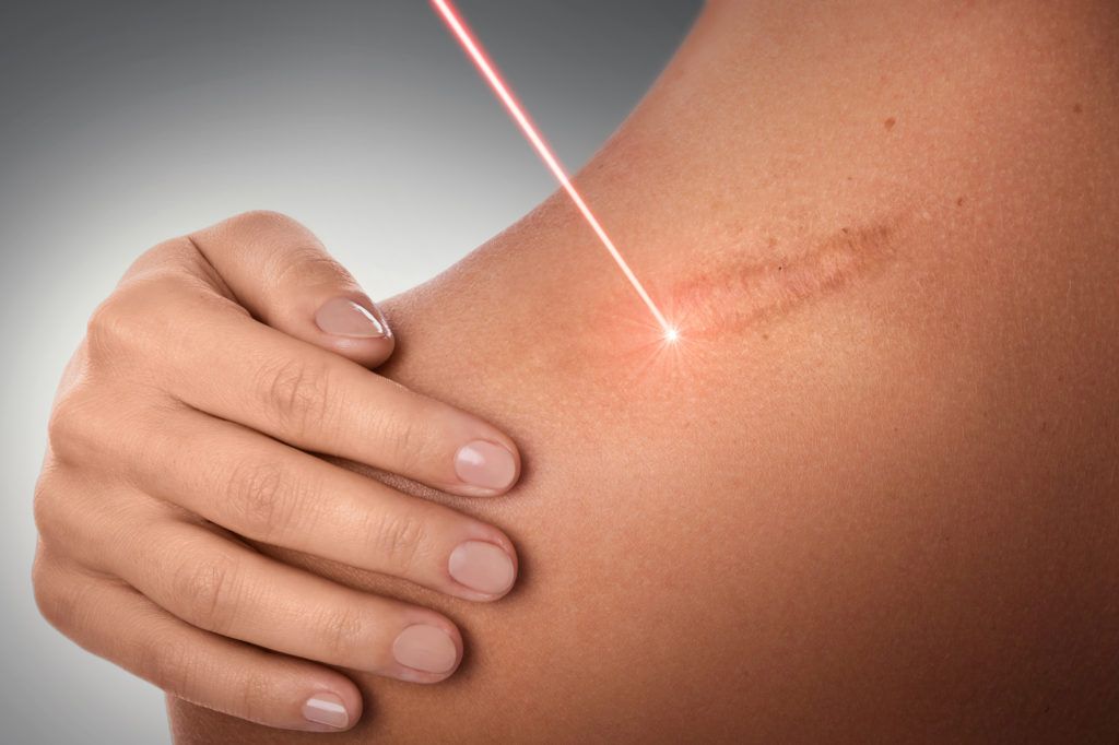 Burn and cut scar removal