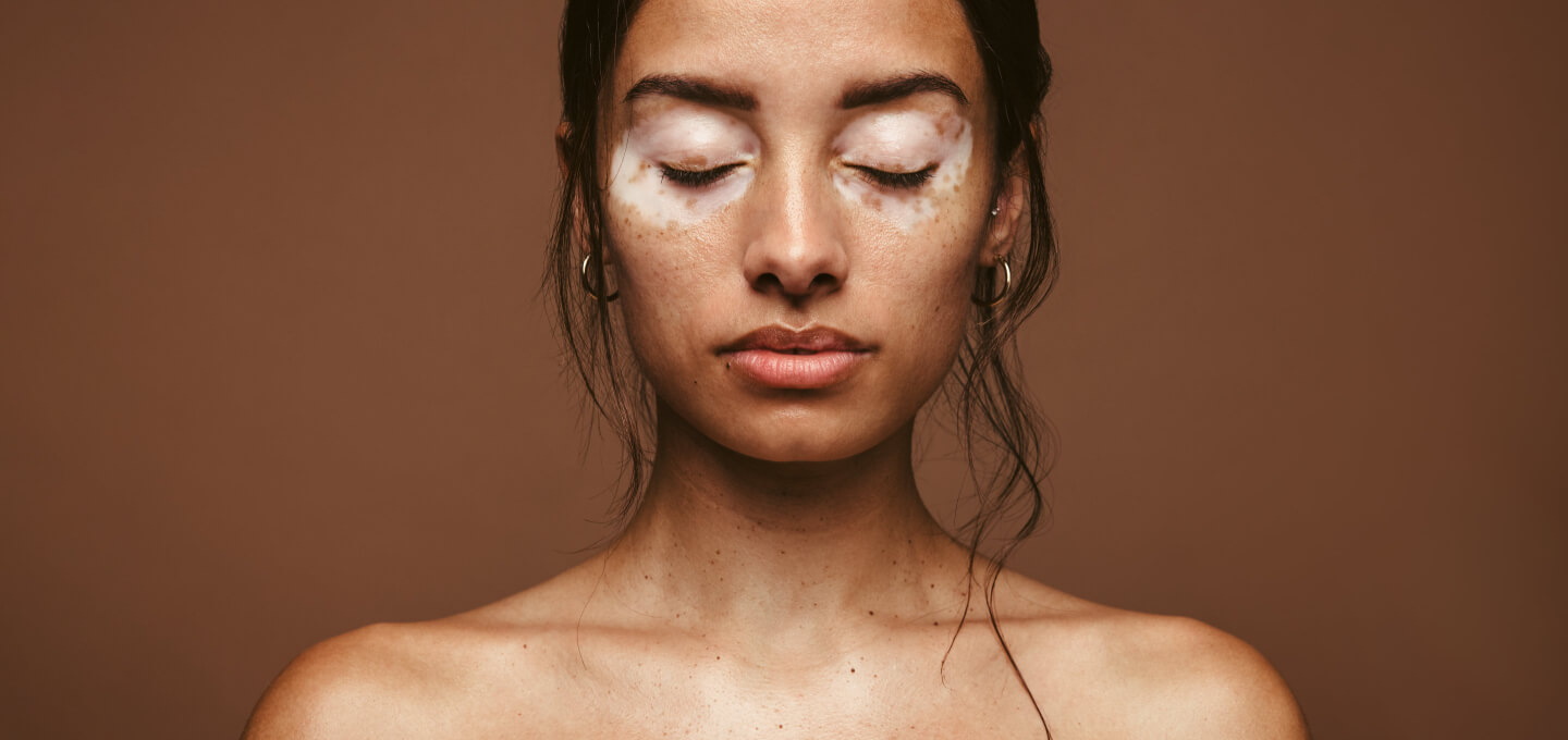Vitiligo treatment